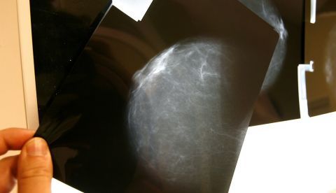 Este hallazgo podría ayudar a los expertos a desarrollar nuevas terapias para combatir subtipos agresivos del cáncer de pecho. EFE/Archivo