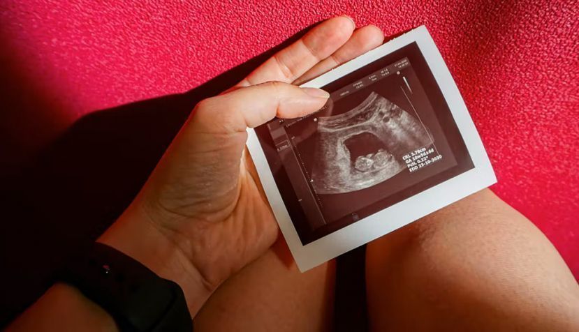 Shutterstock / https://www.shutterstock.com/es/image-photo/pelvic-screening-ultrasound-pregnancy-10-11-1704463945