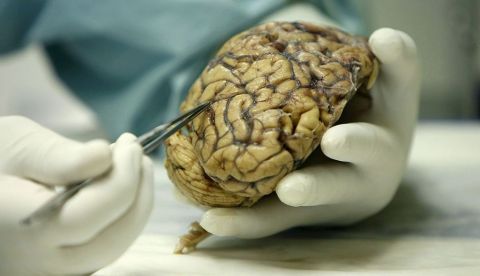 El alzhéimer protege del cáncer de pulmón, pero aumenta el riesgo de tumor cerebral / EFE