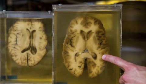 La epilepsia es un trastorno derivado del funcionamiento anormal de un grupo de neuronas que se produce en una zona concreta del cerebro y es la enfermedad neuronal más común, junto a la migraña. EFE/Archivo 	   