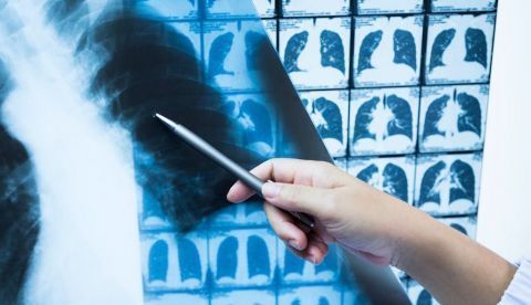 La mitad de pacientes con neumonía por covid sigue afectada 6 meses después