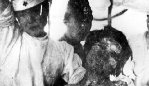 Víctima atómica de Nagasaki. / Wikipedia.