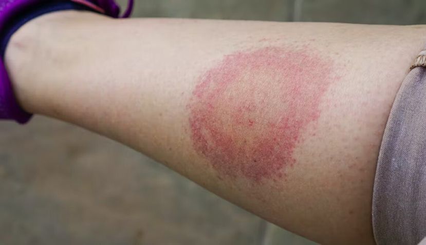 La enfermedad de Lyme es transmitida por la picadura de garrapatas infectadas. Shutterstock / AnastasiaKopa