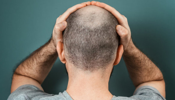 La terapia celular abre una nueva vía para acabar con la calvicie